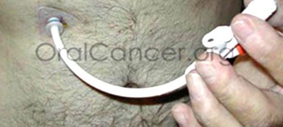 Nutrition / Feeding Systems 3 peg tube